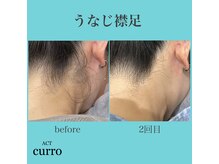 アクト クロ(ACT curro)/【うなじ襟足】脱毛施術例