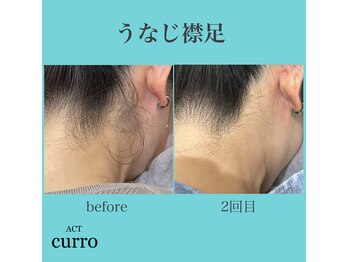 アクト クロ(ACT curro)/【うなじ襟足】脱毛施術例