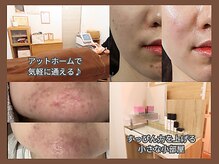 フェリス(feliz)の雰囲気（癒されながら素肌美人に♪ララピール/ハーブピーリング/プラズマ）