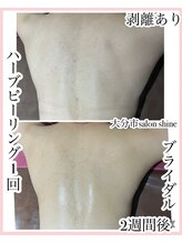 サロンシャイン(Salon Shine)/ハーブピーリング2回