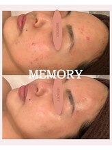 メモリー(MEMORY)/ニキビケア♪