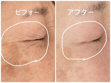 ノーブル シャット Noble Chate/シミだけじゃない！目尻のシワも