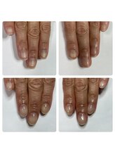 マニュコクーン(ManuCocoon)/爪育成　深爪　巻き爪　大阪市