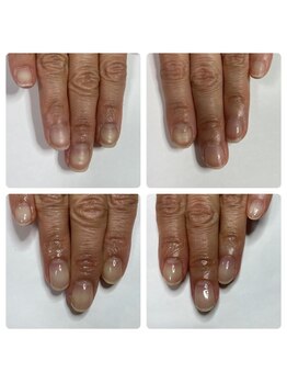 マニュコクーン(ManuCocoon)/爪育成 深爪 巻き爪 大阪市