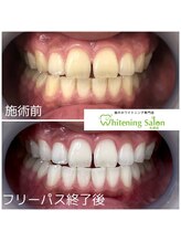 ホワイトニングサロン 札幌店/【ホワイトニング】#札幌#大通り