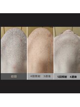 キムラケ 和光別邸(木村家 KIMURAKE)/メンズ脱毛ヒゲビフォーアフター