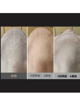 キムラケ 和光別邸(木村家 KIMURAKE)/メンズ脱毛ヒゲビフォーアフター