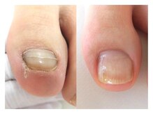 巻き爪ケアサポート ルアナ(LUANA)/Before→After