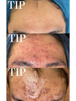 ニコサロン(nico salon)/TIPハーブピーリング