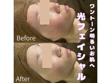 カヨン 新所沢店(KAYON)/乾燥くすみ赤み軽減ケアで美白に