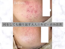 モア 吉祥寺(MORE.)の雰囲気（繰り返すニキビ、跡、赤みを根本から改善します。）