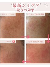 エクラ アン(eclat.un)/最新シミケア【ホワイトラボ】