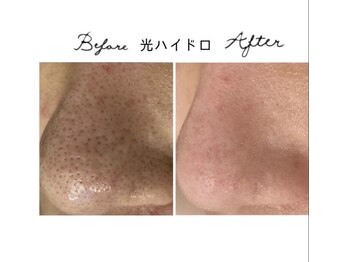 アリュール 倉敷(ALLURE)の写真/素肌に自信が持てる【毛穴の黒ずみ/開き/皮脂/徹底改善◎】繰り返すニキビや長年のニキビでお悩みの方に◎