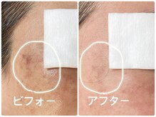 ノーブル シャット Noble Chate/見て！長年、気にしていたシミが