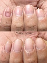 マリーロール 淀屋橋本店(Marie Laure)/自爪育成/深爪矯正/ネイルケア