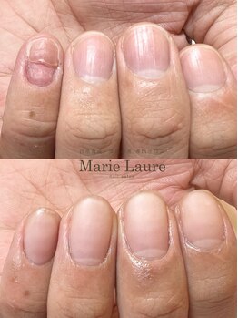 マリーロール 淀屋橋本店(Marie Laure)/自爪育成/深爪矯正/ネイルケア