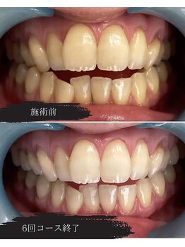 グロウ 東区香椎(GLOW)/本格ホワイトニング