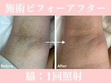 ラクワン(R coin)/脱毛