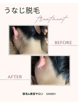 シロ(SHIRO)/うなじ脱毛