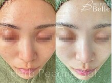 ベル 門前仲町(Belle)/ハーブピーリング|ニキビケア