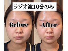 ステラ(Stella)/ラジオ波10分