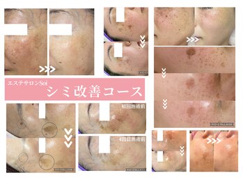 ソイ(Soi)/40代からの本気のシミケアサロン