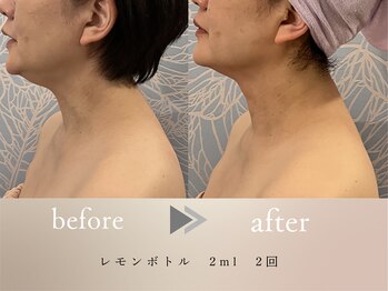 グロッシー(glossy)/【症例レモンボトル顎下40代