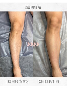 エール(AEELE)/■足脱毛■