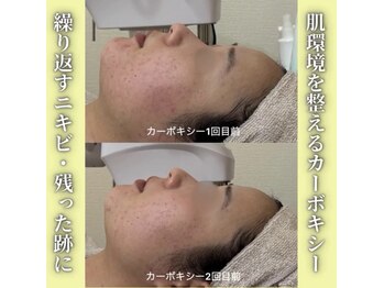 ハニエル(Haniel)/カーボキシー症例