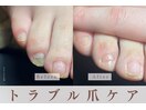 トラブル爪ケア