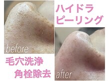 ハイドラピーリングで毛穴洗浄！