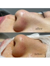 シャルム ド ケー(charme de k)/最強毛穴洗浄