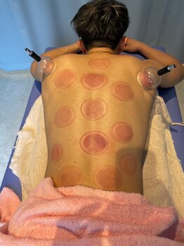 松戸駅前鍼灸院 整骨院/カッピング/オイル/リンパ