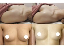 ロットプラス(Lot Plus)の雰囲気（ボリューム、下垂、左右差、離れ乳、ハリ・弾力）