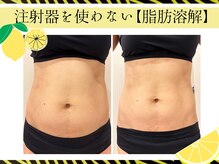 クリニカルエステ/イーズ パークプレイス大分店の雰囲気（レモンボトル１回の効果！痩せたいけど時間かけたくない方必見？）