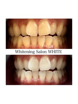 ホワイトニングサロン ホワイト 津山店(WHITE)/ビフォーアフター