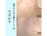 細かいシミやモヤモヤシミ・ゆらぎ肌・敏感肌の方へ