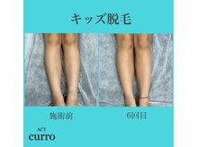 アクト クロ(ACT curro)/【キッズ】脱毛施術例