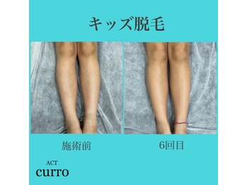アクト クロ(ACT curro)/【キッズ】脱毛施術例