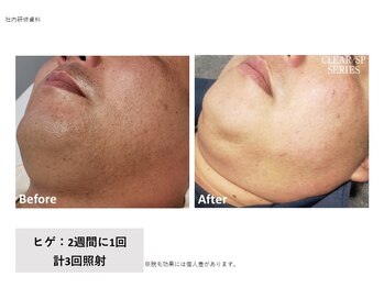 ルミナス 八尾店(Luminous)/ヒゲ脱毛3回目