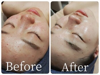 サロン ド ヒノキ(Salon de HINOKI)/ニキビケア☆ハーブピーリング