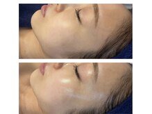 シルグラン(SIL gran)/光沢艶肌ピール1回前後