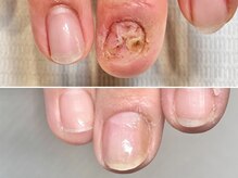 グラシュータン(gracieux temps)/【深爪矯正1本からでもOK】