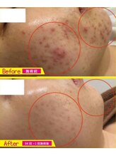 チェリオール(Cherioll)/リブセラプラズマトリートメント