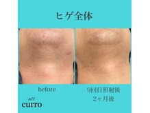 アクト クロ(ACT curro)/【ヒゲ全体】脱毛施術例