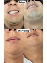 ビーンズ(BEANS)/ヒゲ脱毛