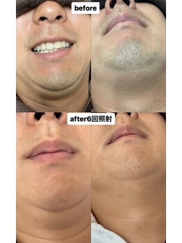 ビーンズ(BEANS)/ヒゲ脱毛