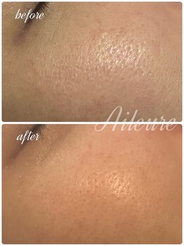 エルール トータルビューティ(Aileure total beauty)/肌を育てるピーリングララピール