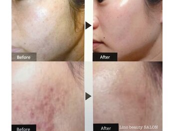 リノ(Lino)/肌質改善スキンケアプログラム