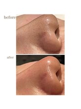 ユジュ(yju)/毛穴の開き　黒ずみ　角栓